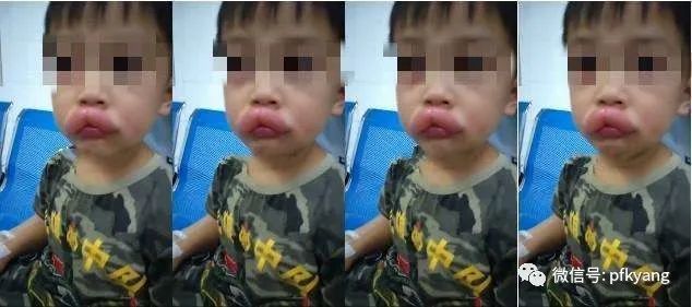 男孩吃葡萄過敏腫成嘟嘟嘴怎么回事？畫面詳情曝光網(wǎng)友忍不住笑了(圖2)