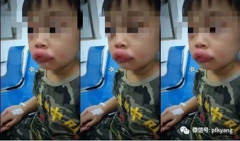 男孩吃葡萄過(guò)敏腫成嘟嘟嘴怎么回事？畫(huà)面詳情曝光網(wǎng)友忍不住笑了