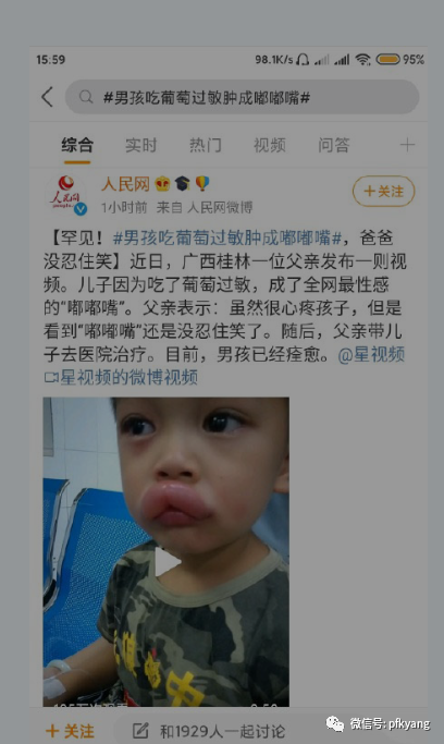 男孩吃葡萄過敏腫成嘟嘟嘴怎么回事？畫面詳情曝光網(wǎng)友忍不住笑了(圖3)