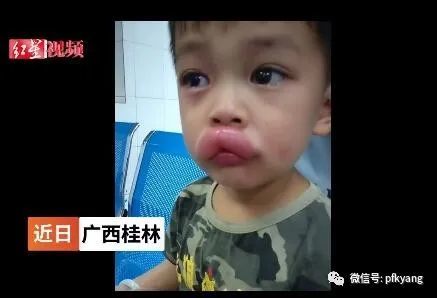 男孩吃葡萄過敏腫成嘟嘟嘴怎么回事？畫面詳情曝光網(wǎng)友忍不住笑了(圖5)